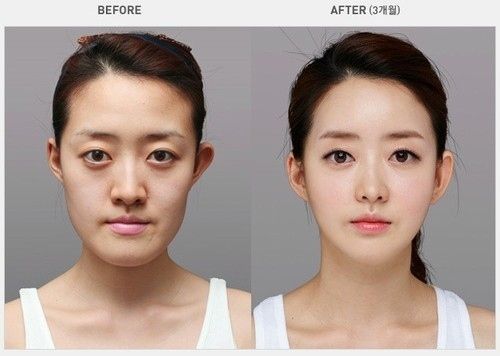 Facial Reconstruction Surgery